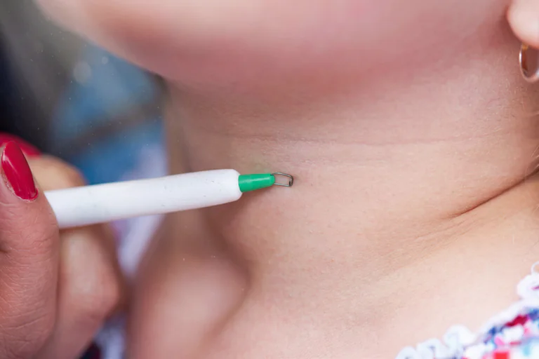 Person med rött nagellack markerar en födelsemärke på en hals med en grönmarkeringspenna.